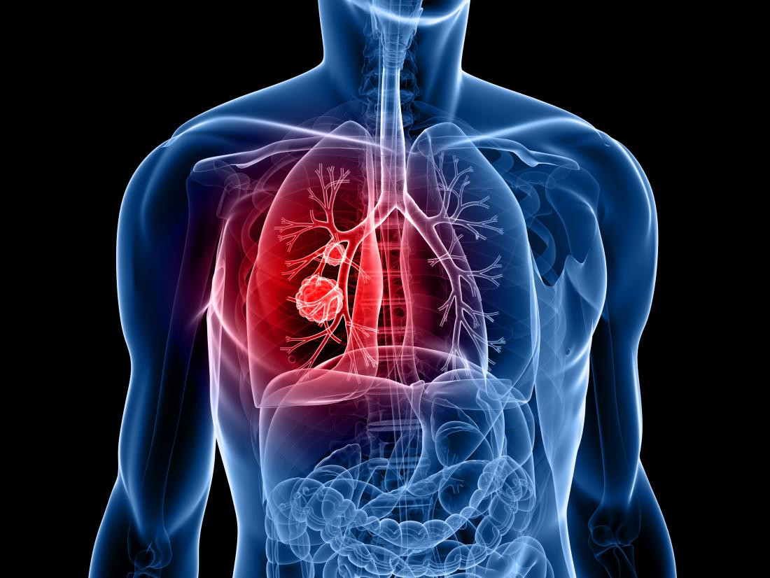 Atezolizumab